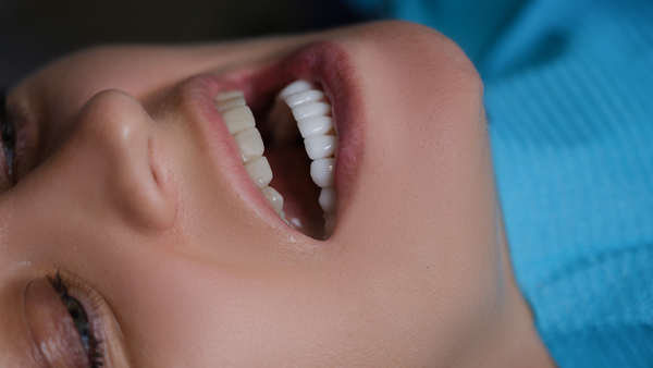 How Veneers Can Improve Teeth Appearance