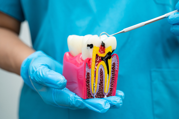 Root Canal Aftercare: Tips For A Smooth Recovery